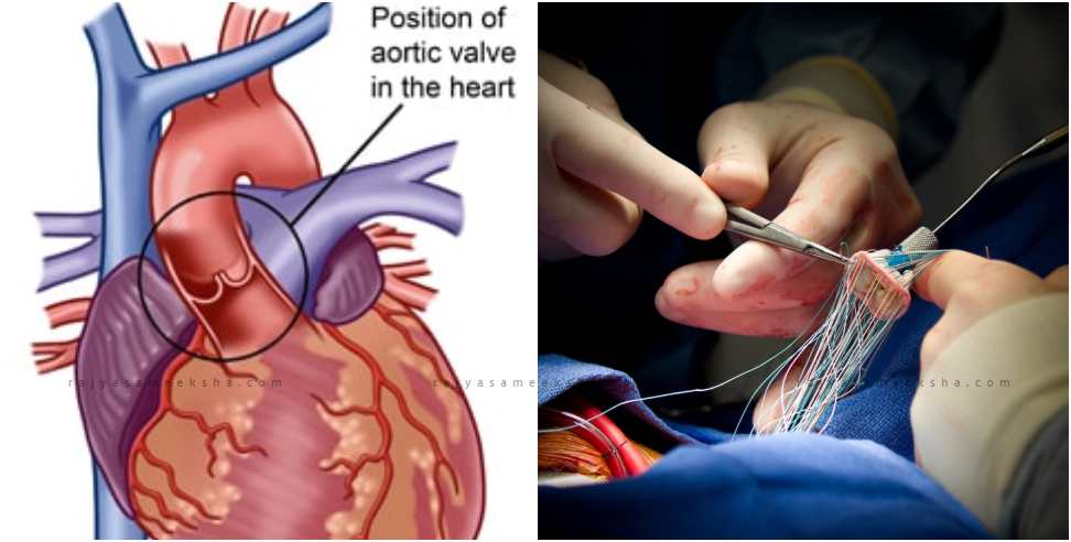 Biggest heart surgery: Graphic Era Hospital Experts Replaced Heart Valve Without Any Incision