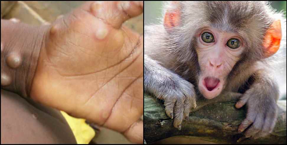 uttarakhand monkeypox Symptoms Prevention : Monkeypox alert in Uttarakhand know Symptoms and Prevention