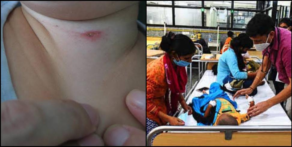 Uttarakhand Scrub typhus: Scrub typhus in uttarakhand