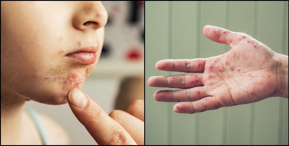 Hand Foot Mouth Disease Uttarakhand: Hand Foot Mouth Disease Uttarakhand Symptoms and Prevention