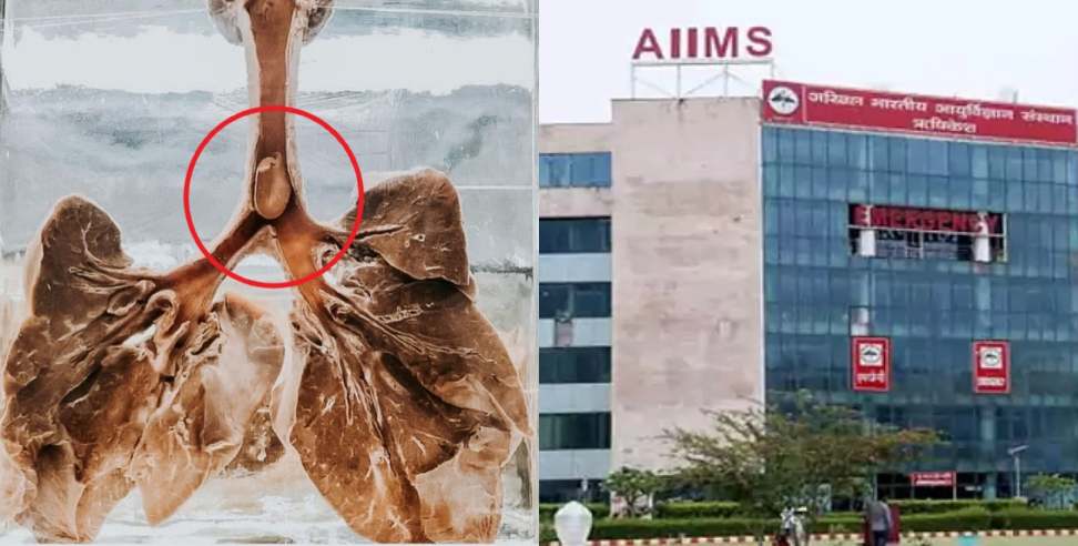 Peanut stuck in trachea AIIMS Rishikesh doctors save girl life
