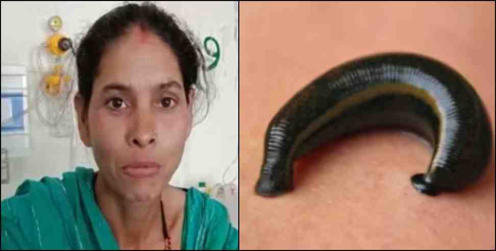 A live leech came out of Deepa Devi nose in Srinagar Garhwal