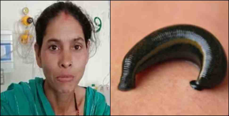 srinagar garhwal deepa devi nose leech: A live leech came out of Deepa Devi nose in Srinagar Garhwal