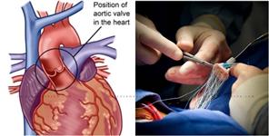 Graphic Era Hospital Experts Replaced Heart Valve Without Any Incision