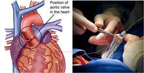 image: Graphic Era Hospital Experts Replaced Heart Valve Without Any Incision