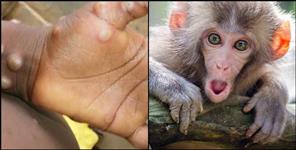image: Monkeypox alert in Uttarakhand know Symptoms and Prevention