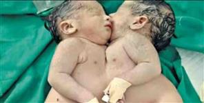 image: Conjoined twins born in Haridwar