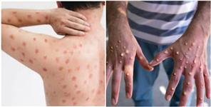 image: Monkey pox Alert in Uttarakhand