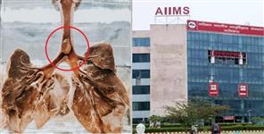 image: Peanut stuck in trachea AIIMS Rishikesh doctors save girl life