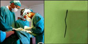 image: Doctors removed the needle after performing lung operation