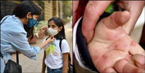 image: 28 Cases of Viral Fever Tomato Flu Symptoms and Prevention