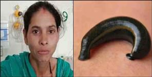 image: A live leech came out of Deepa Devi nose in Srinagar Garhwal
