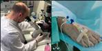 Monkeypox in Uttarakhand Symptoms and Home Remedies