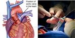 Graphic Era Hospital Experts Replaced Heart Valve Without Any Incision
