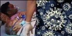 Rishikesh AIIMS Black Fungus