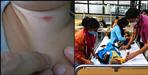 Scrub typhus in uttarakhand