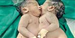 Conjoined twins born in Haridwar