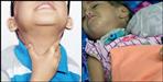 Diphtheria disease in Bageshwar