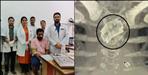 Dehradun doctors removed blade from alimentary canal of patient