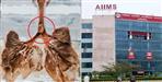 Peanut stuck in trachea AIIMS Rishikesh doctors save girl life