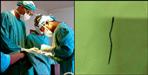 Doctors removed the needle after performing lung operation
