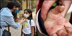 28 Cases of Viral Fever Tomato Flu Symptoms and Prevention