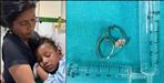 3 year old boy swallowed toe ring Bageshwar