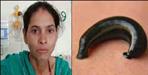 A live leech came out of Deepa Devi nose in Srinagar Garhwal
