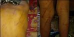7-year-old quit school after brutally beaten by teacher