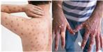 Monkey pox Alert in Uttarakhand